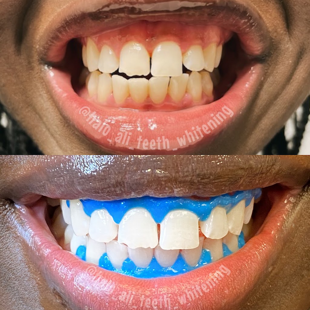 Halo Ali Teeth Whitening | 2930 Jasper St Suite 316, Philadelphia, PA 19134 | Phone: (866) 683-5117